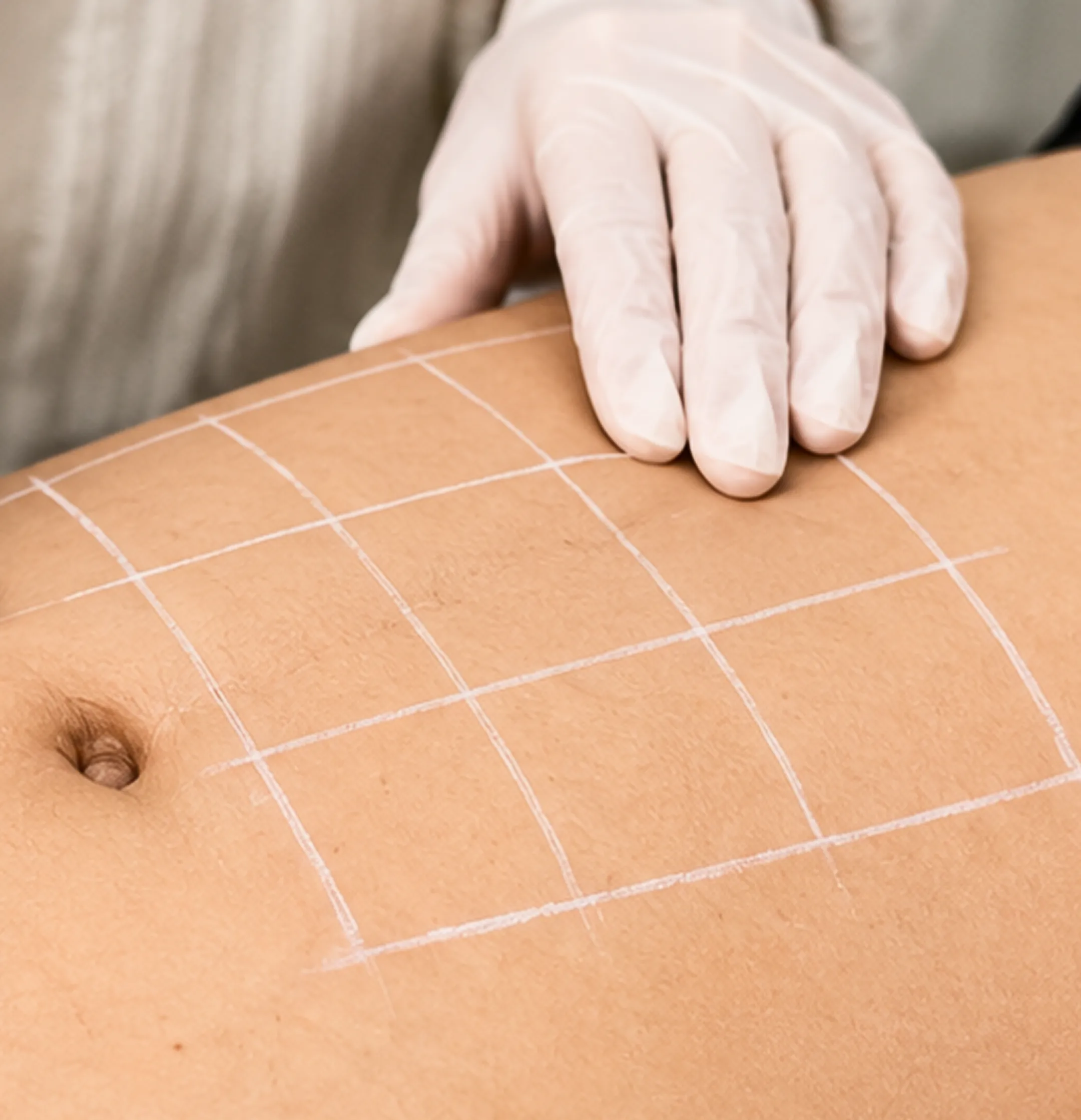 Stretch Mark