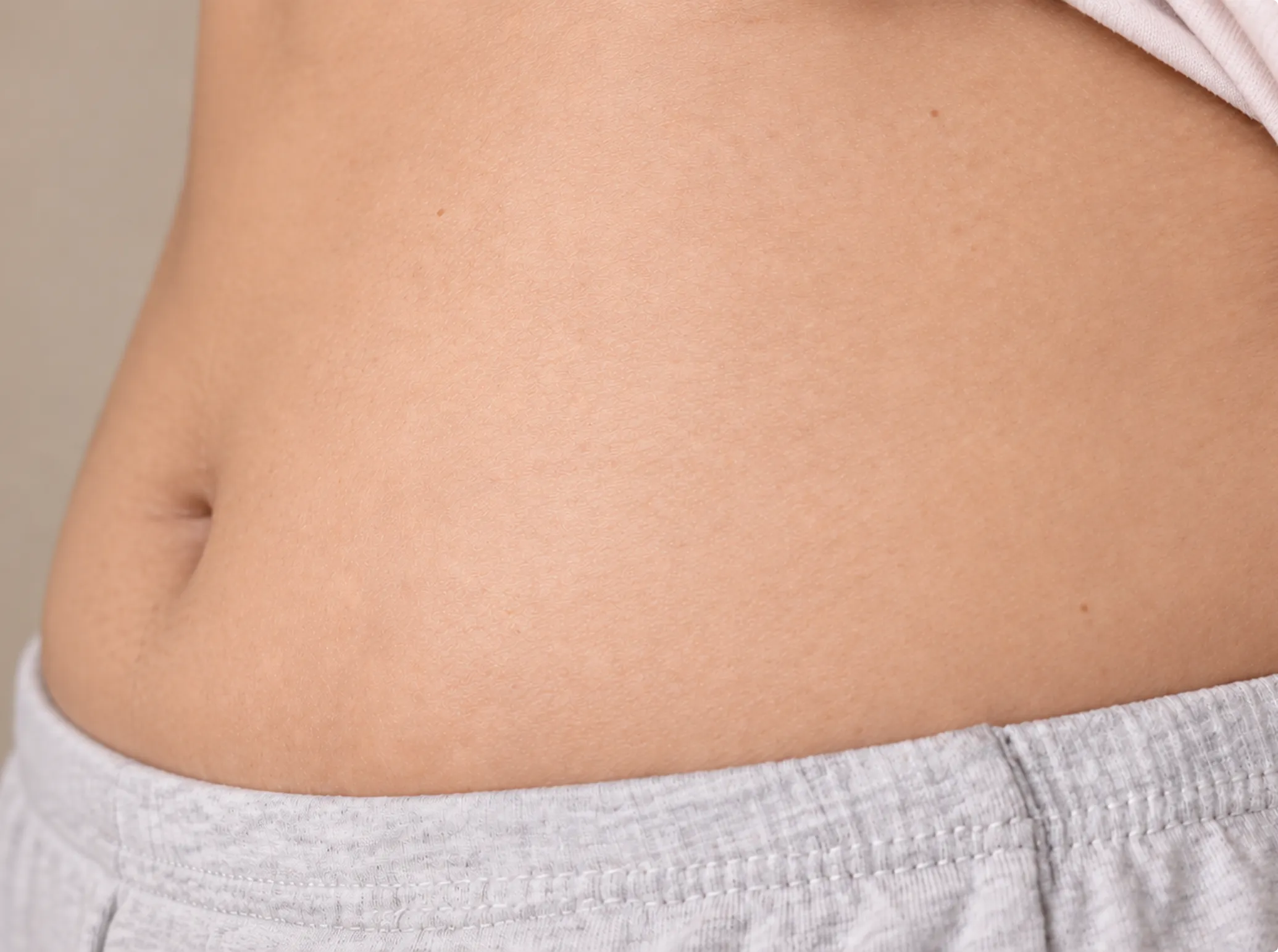 Stretch Marks Removal, after