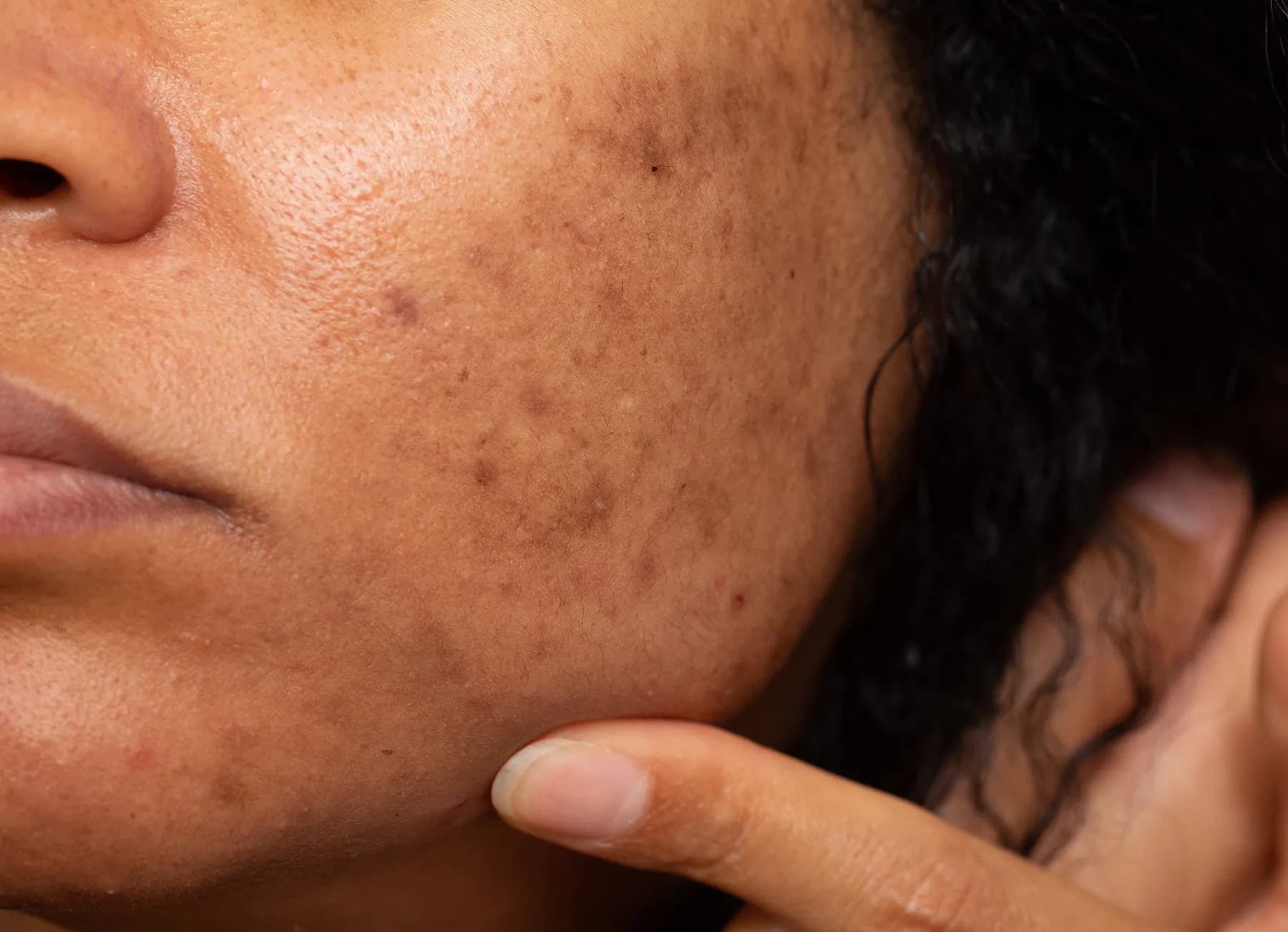 Pigmentation & Melasma