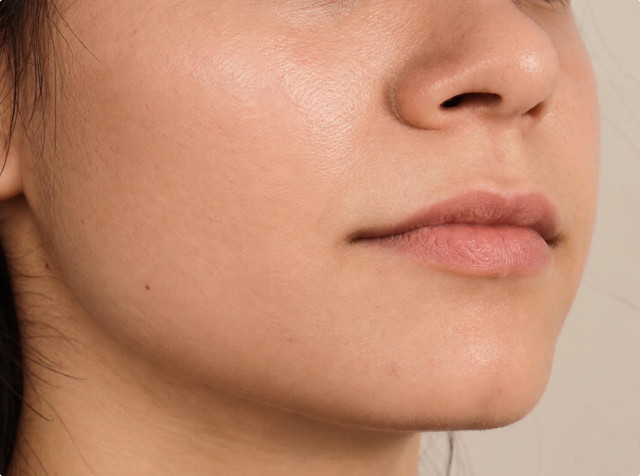Profhilo, after