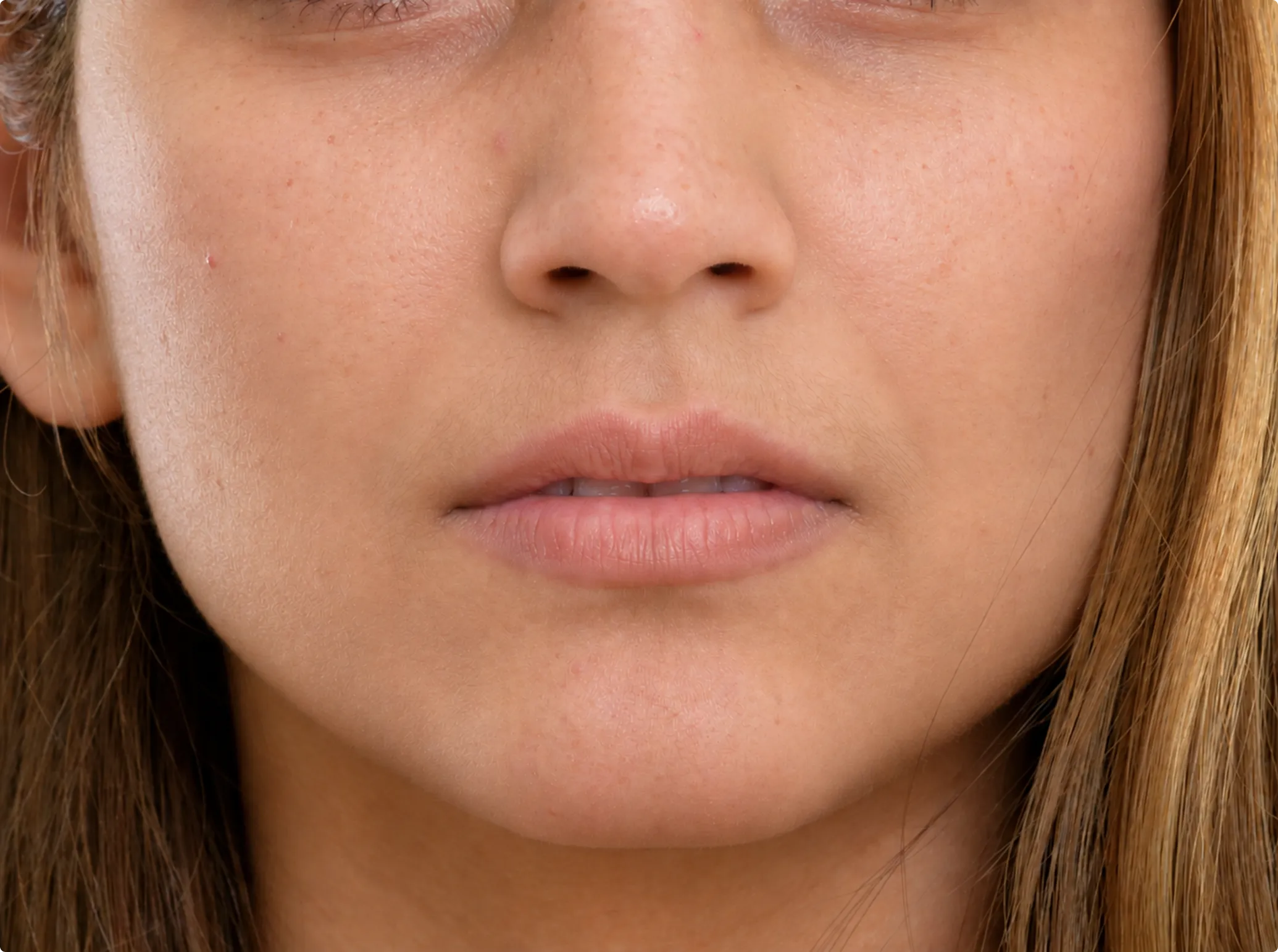 Sculptra, after