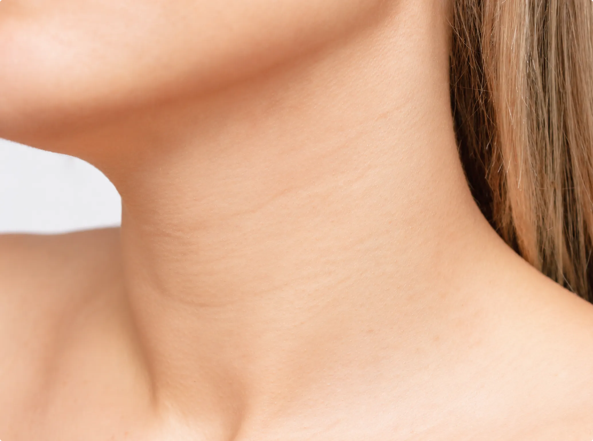 Neck Lines Correction Treatment, after