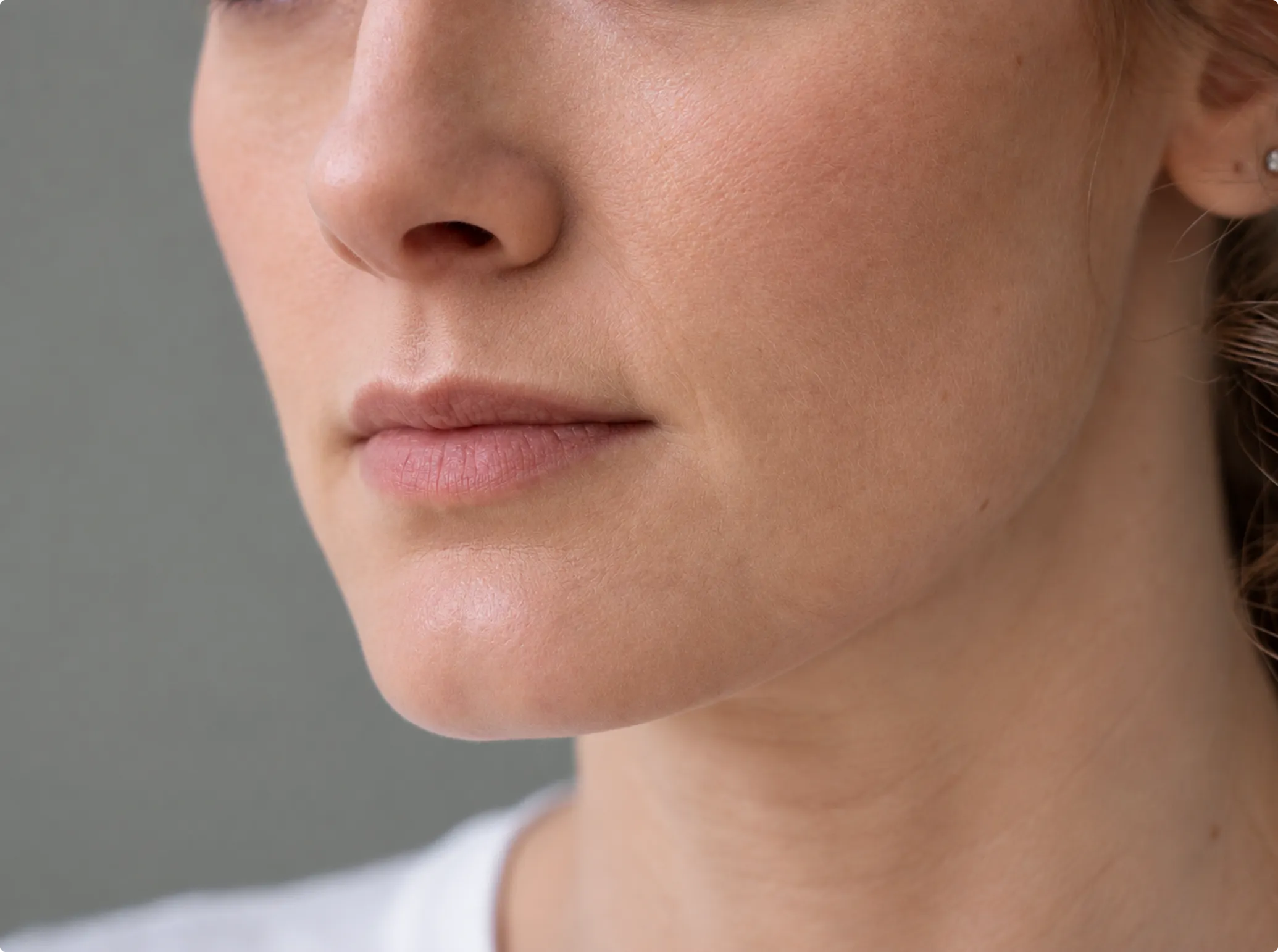 Ultherapy, before
