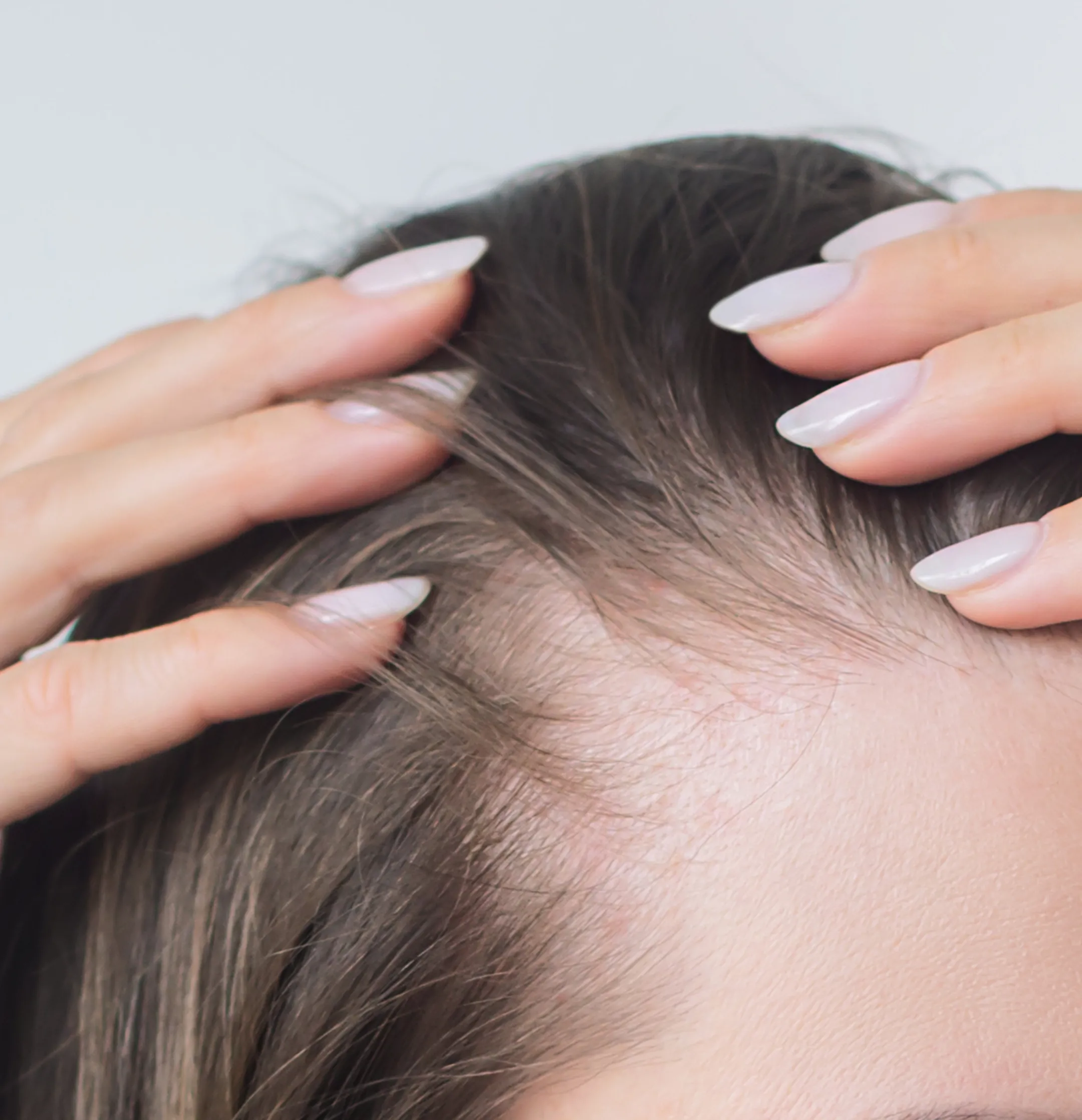 Hair Loss