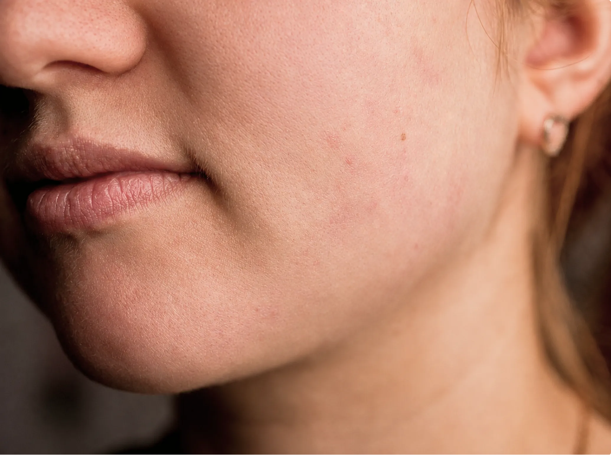 Acne Control Peel, after