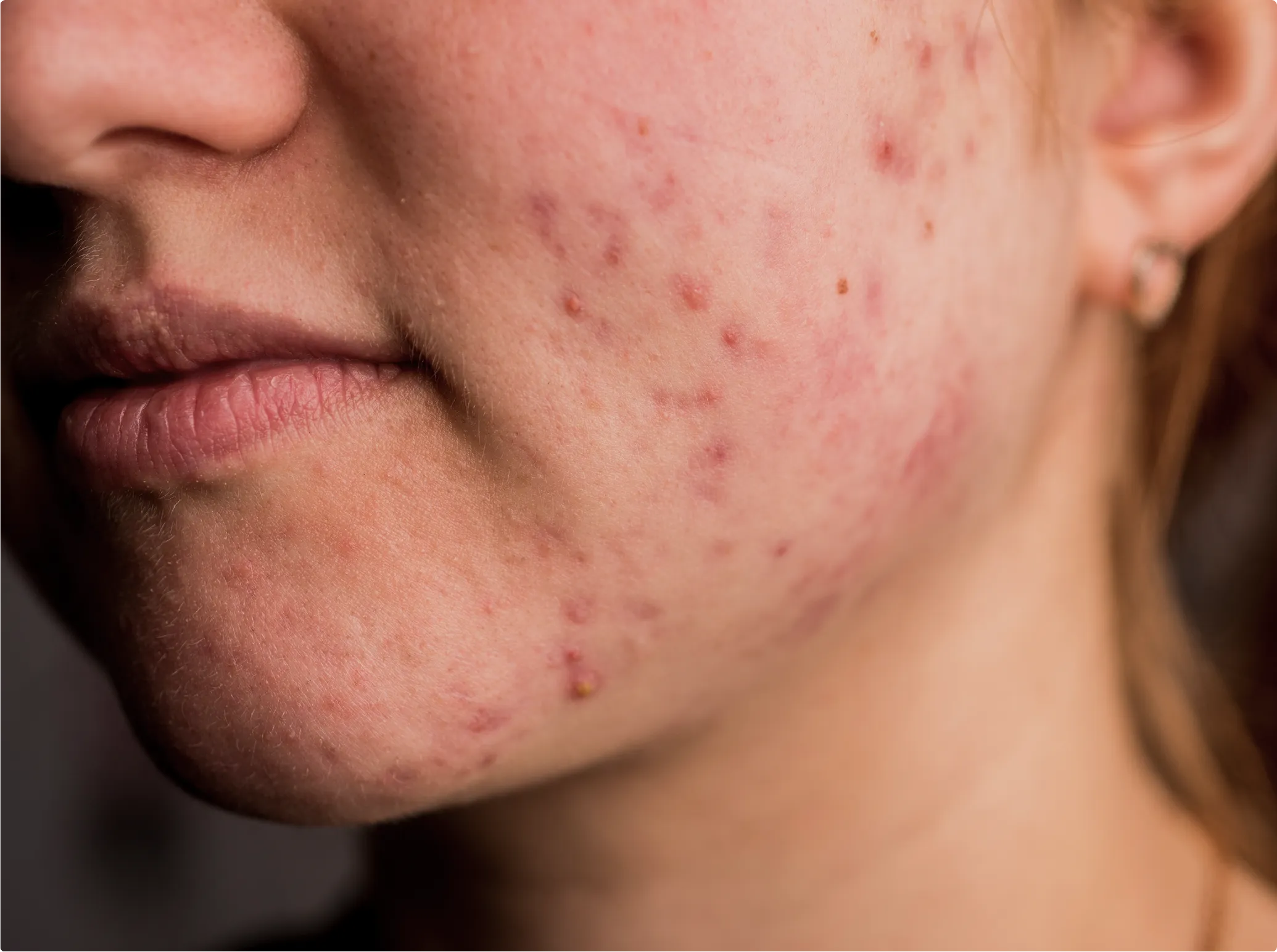 Acne Control Peel, before