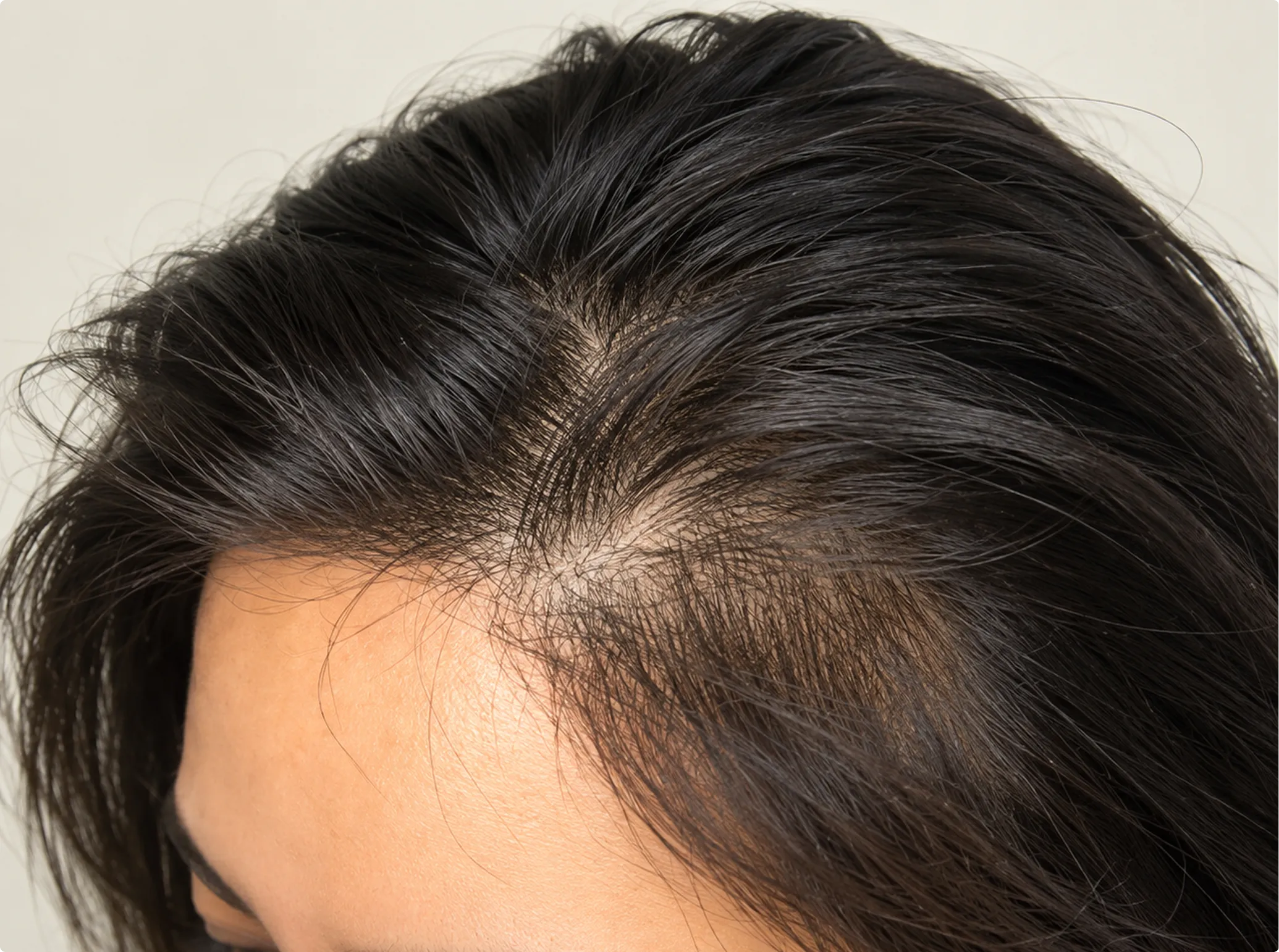 Scalp Micropigmentation, before
