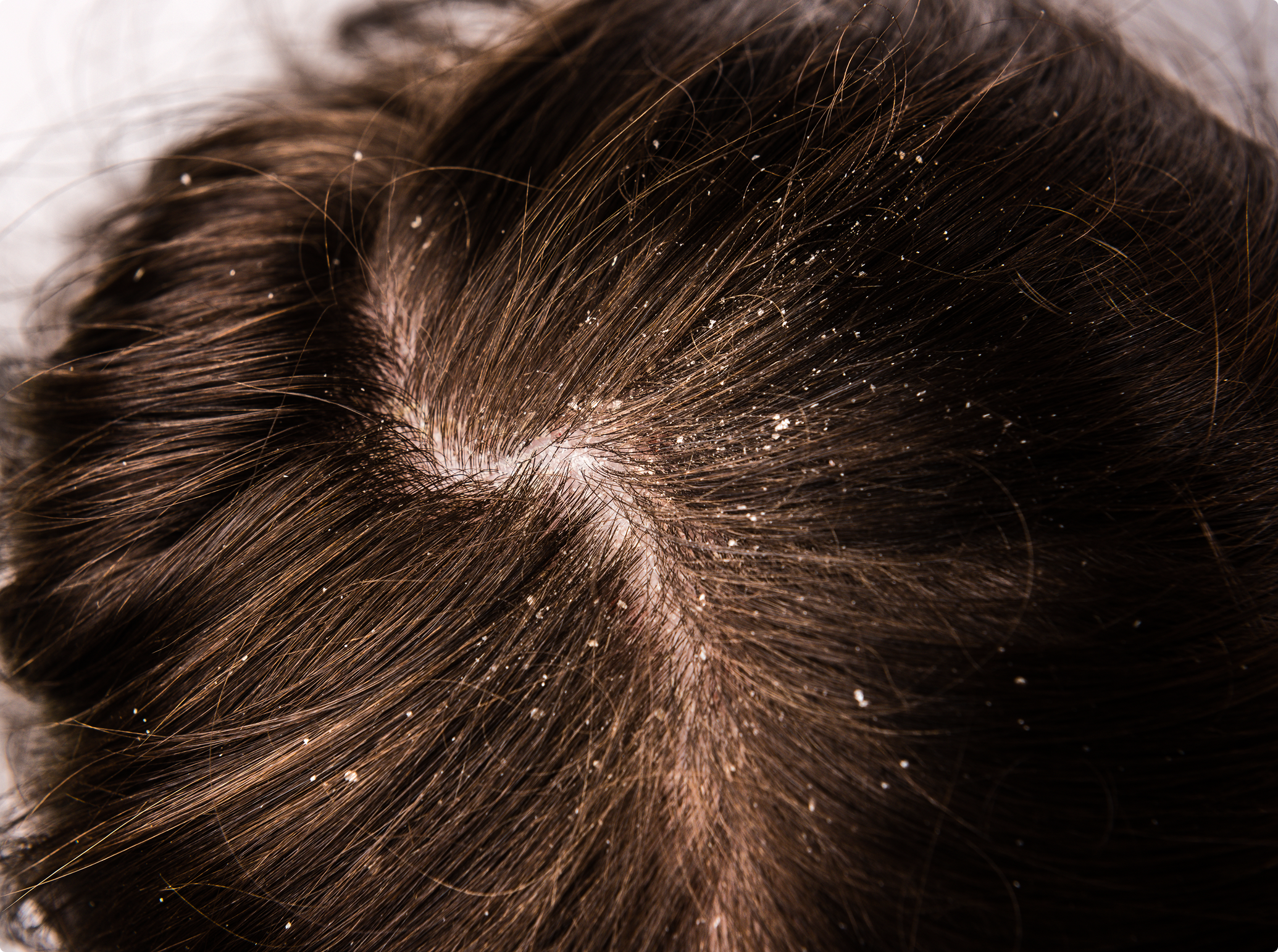 Dandruff Treatment, before