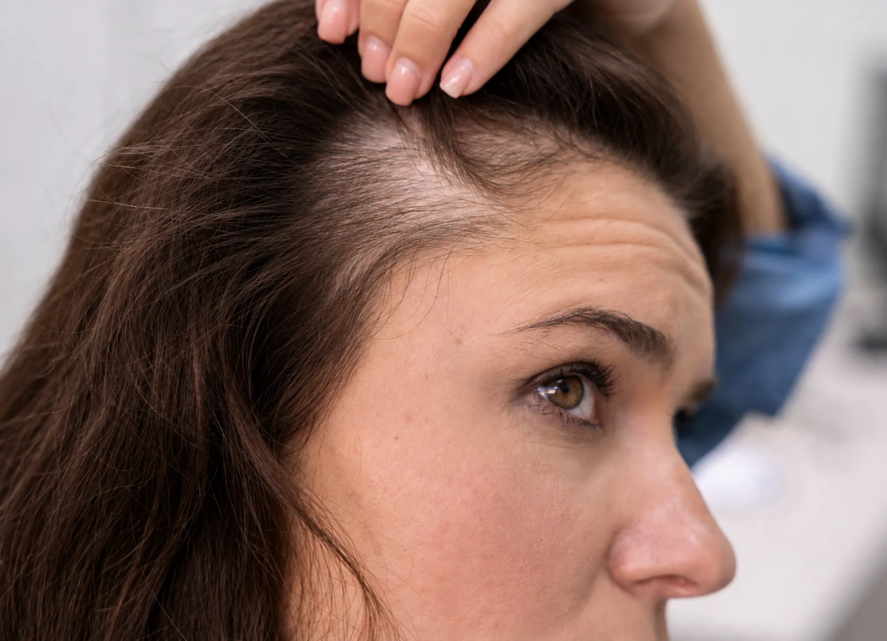 Hair Fall & Balding