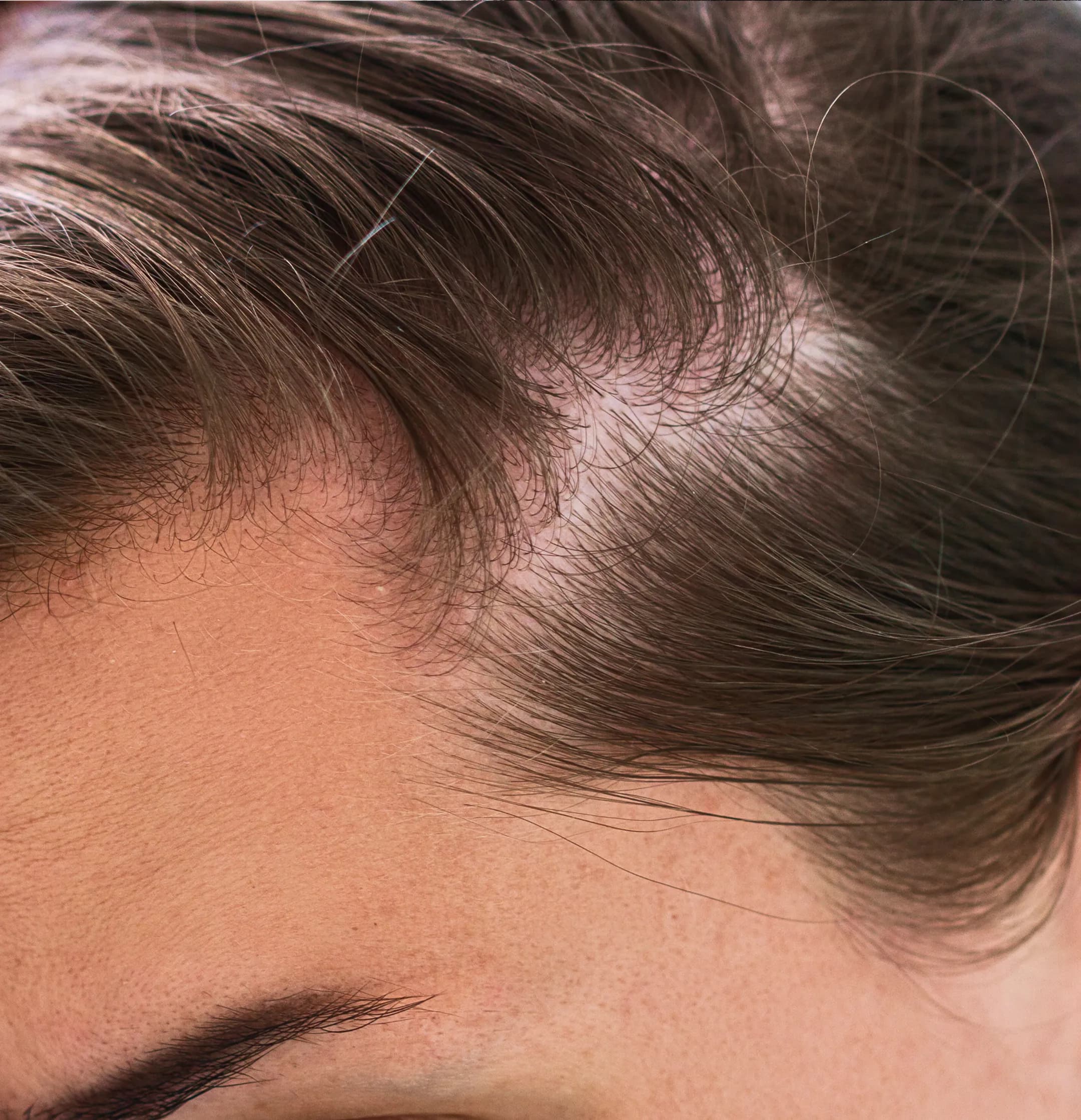 Hair Fall & Balding