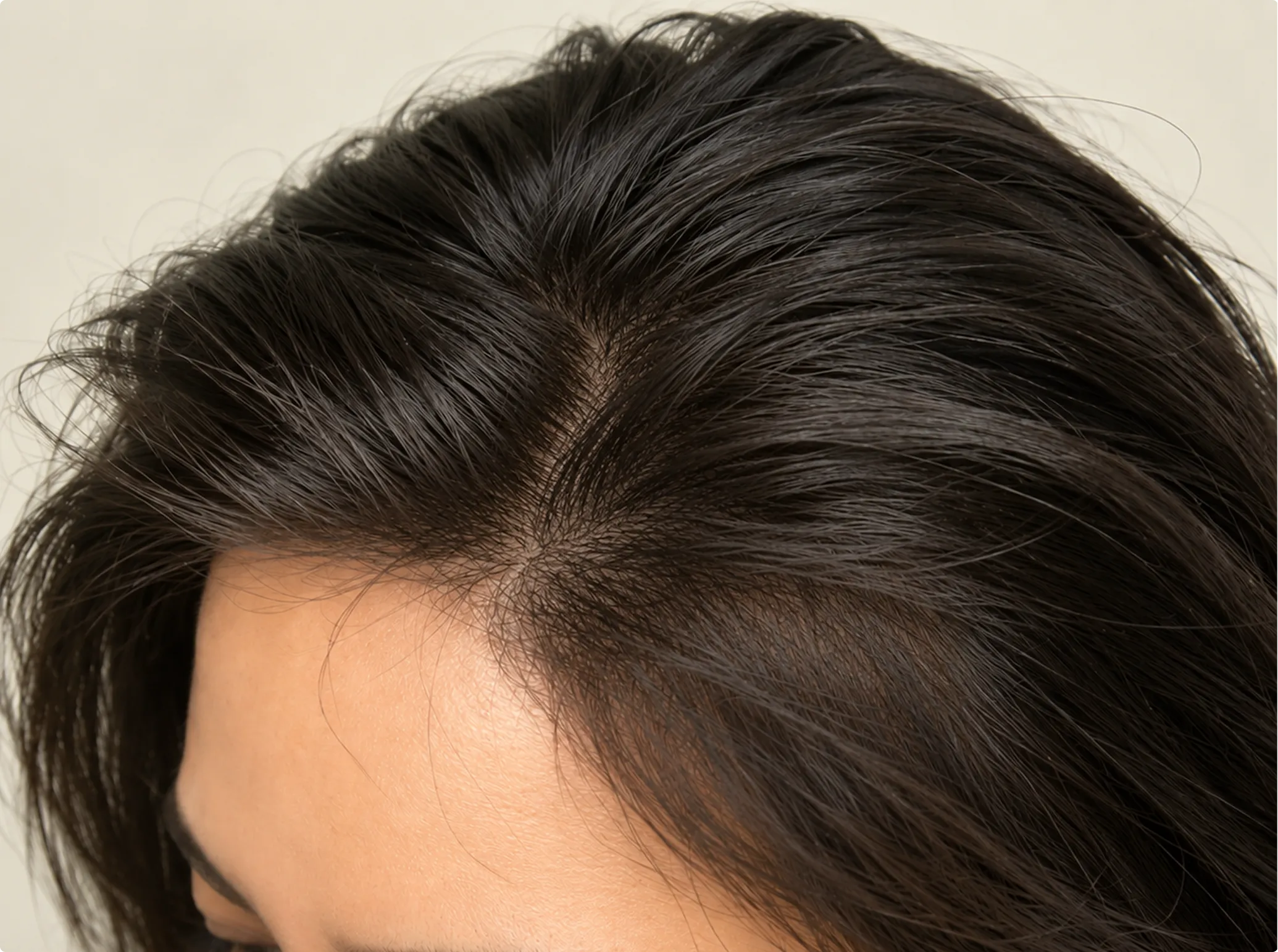 Scalp Micropigmentation, after