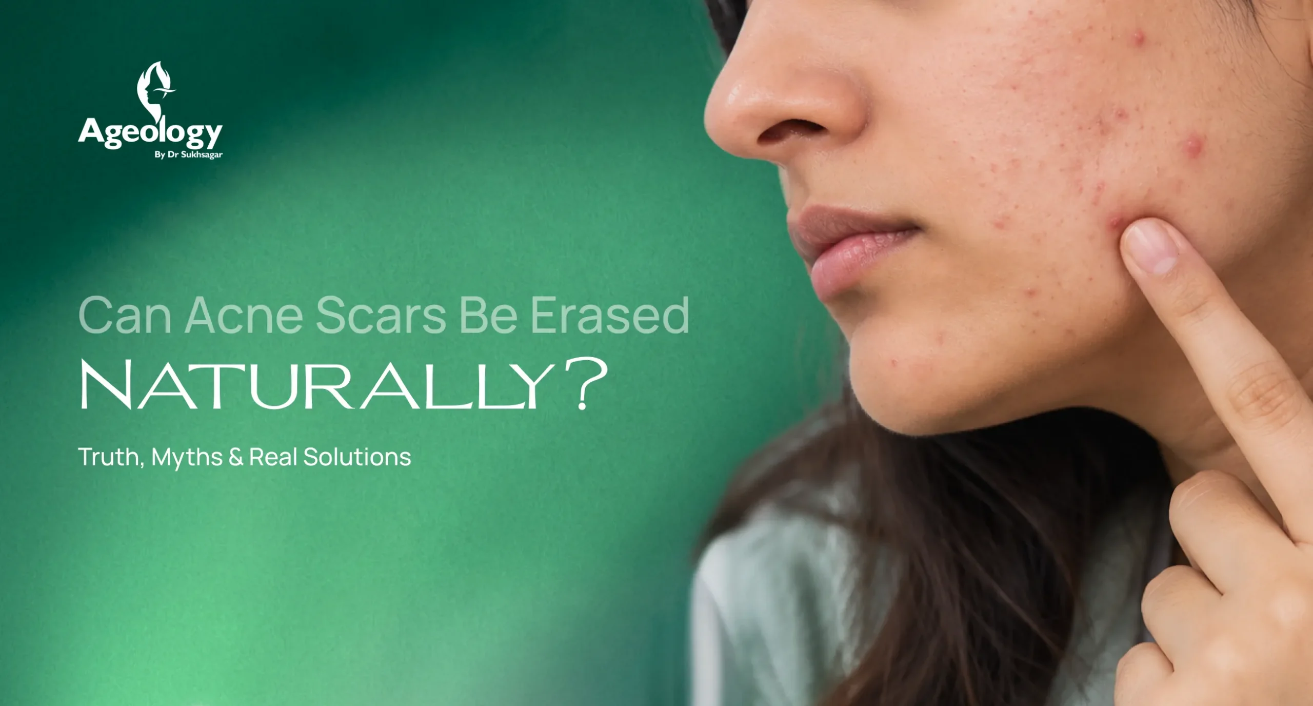 How to Remove Acne Scars Naturally: Myths & What Actually Works