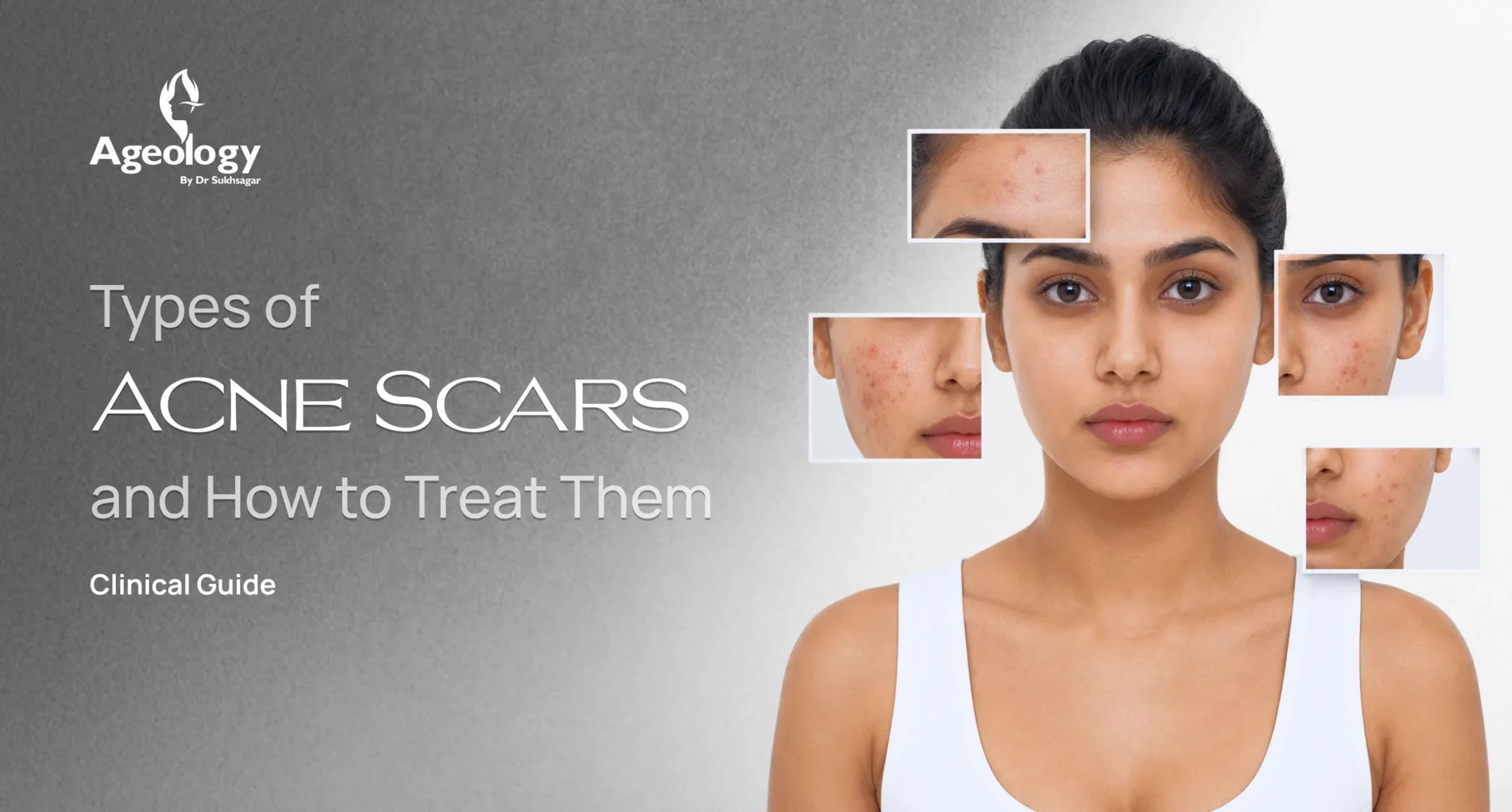 Types of Acne Scars and How to Treat Them: Clinical Guide